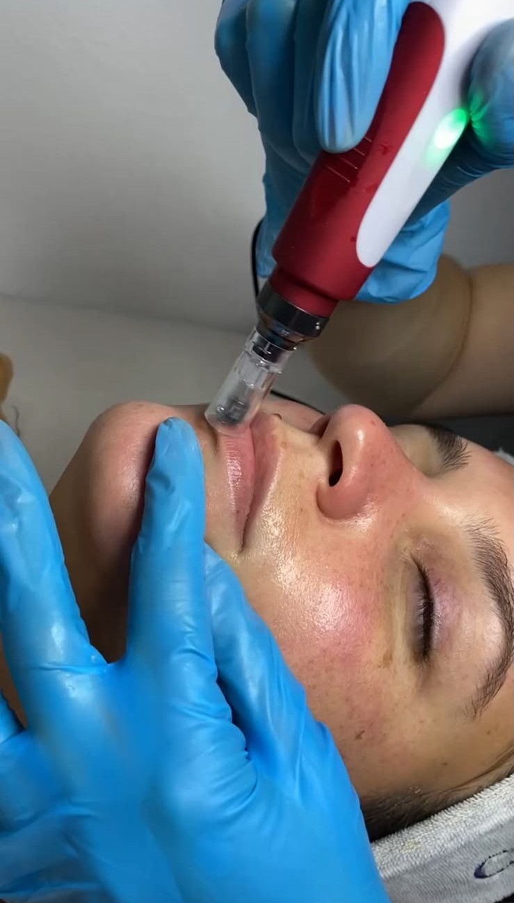 Limpieza Facial Renovadora con Dermapen